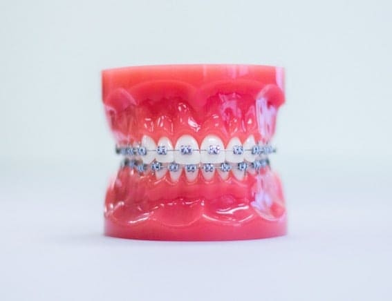 Metal Braces at Topsmiles Pediatric Dentistry and Orthodontics