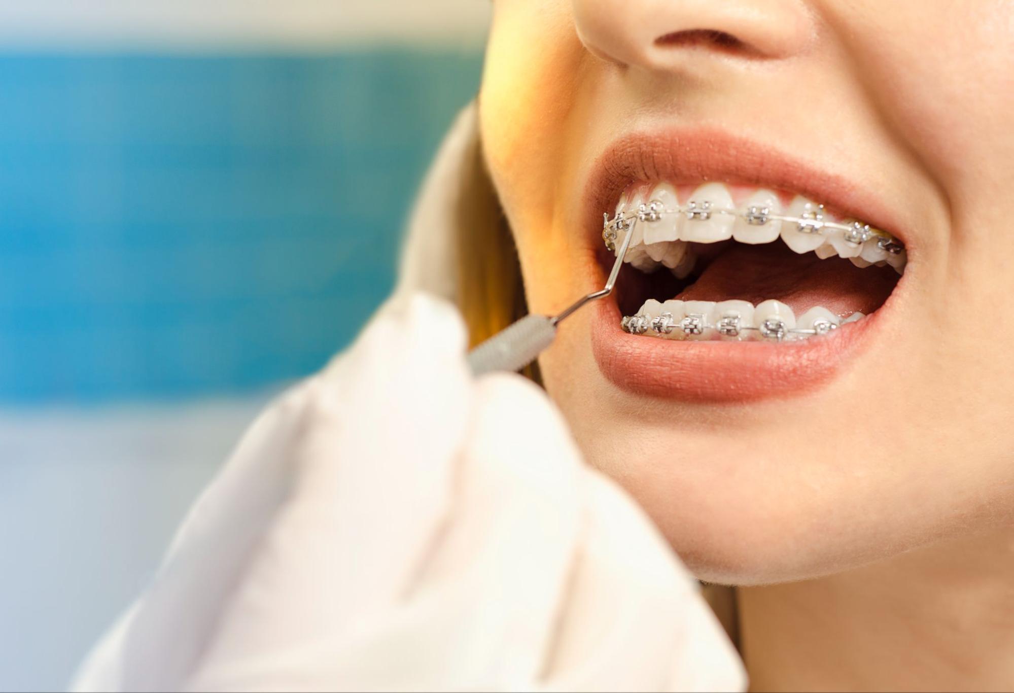 Addressing Common Braces Concerns: Tightening, Wire Pokes, and Ulcers